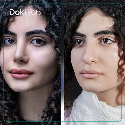 نتیجه جراحی توسط بهترین دکتر جراح بینی گوشتی در تهران؛ دکی یاب