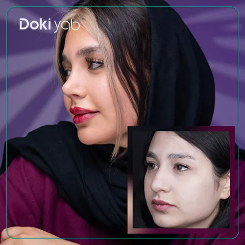 هترین دکتر جراح بینی گوشتی در تهران؛ نمونه عمل شده با مشاوره دکی‌ یاب