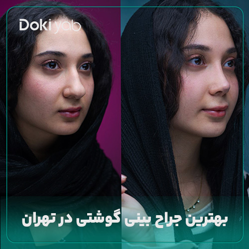 بهترین جراح بینی گوشتی در تهران