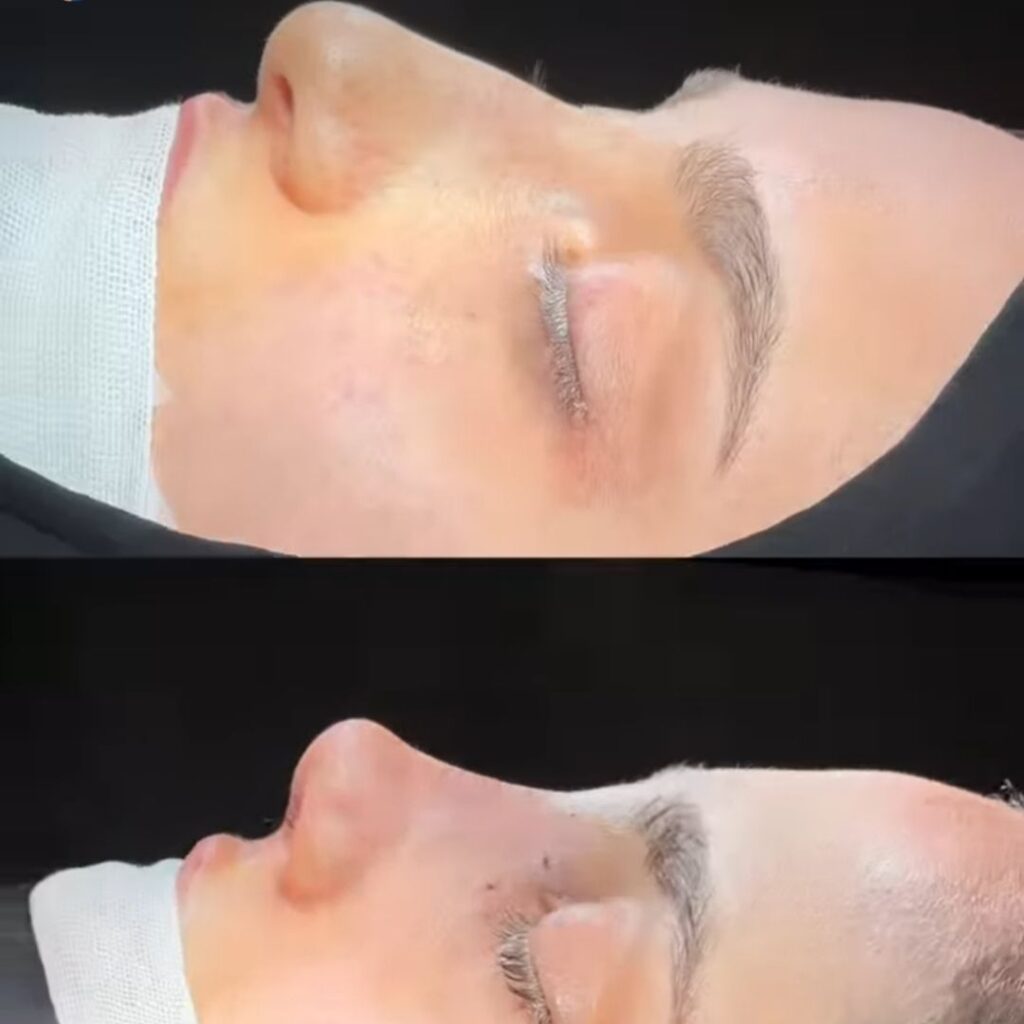 نمونه کار عمل بینی دکتر نادیا گودرزی؛ بهترین جراح بینی در لرستان