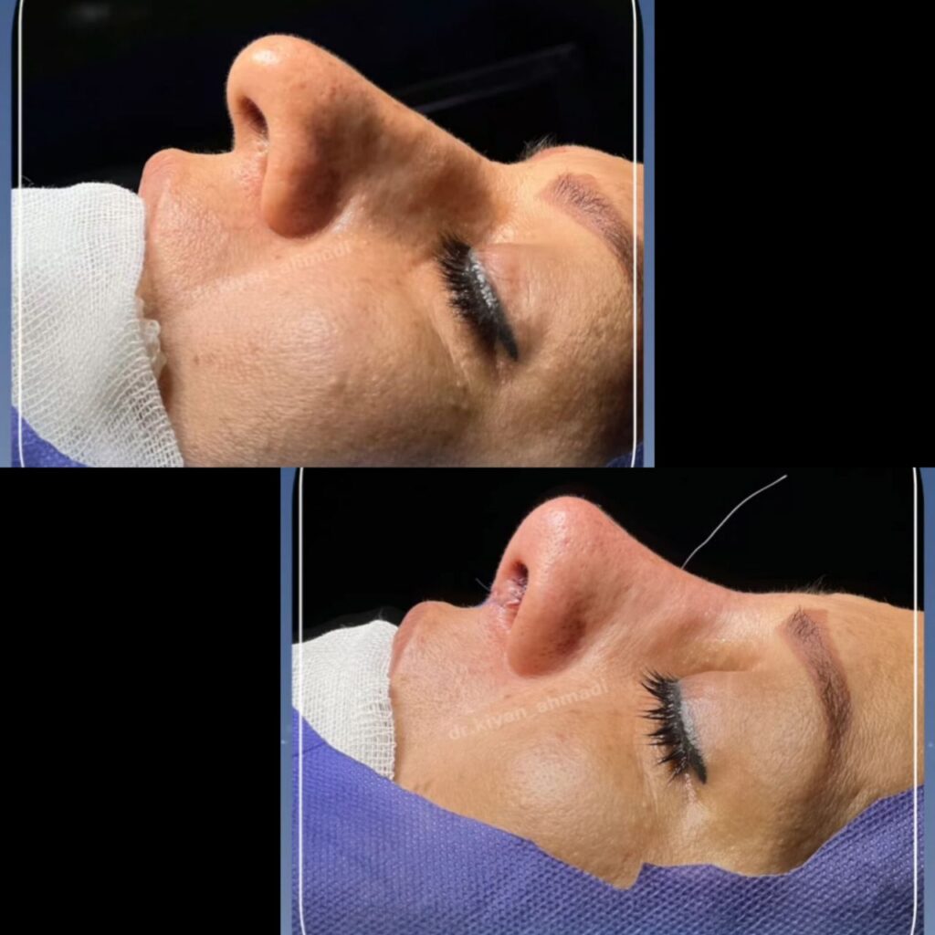 نمونه کار عمل بینی دکتر کیان احمدی؛ بهترین جراح بینی در لرستان
