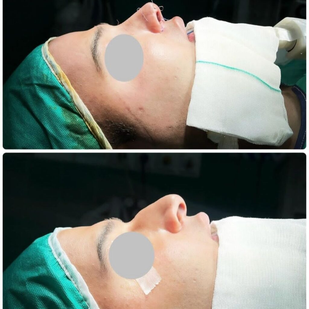 نمونه کار عمل بینی دکتر سیده مهتاب اشجع آوران؛ بهترین جراح بینی در لرستان
