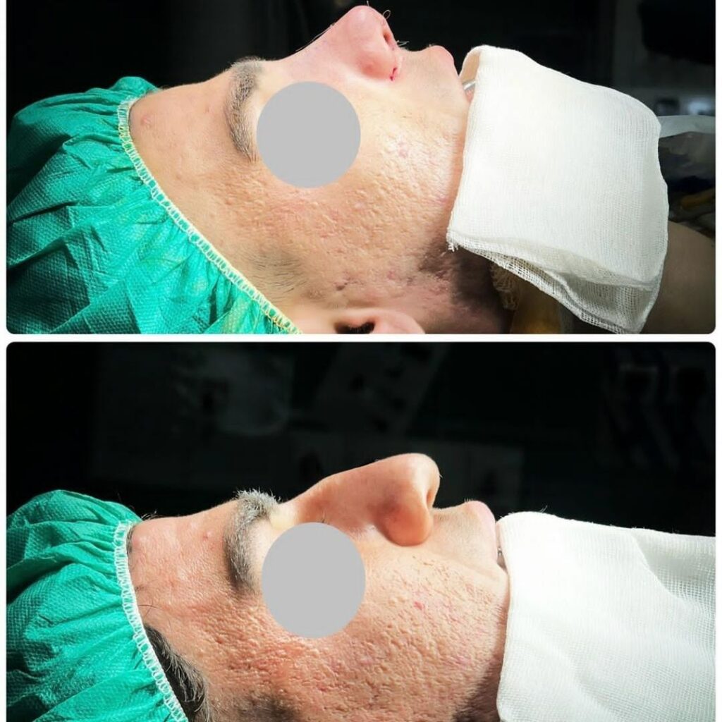 نمونه جراحی بینی دکتر سیده مهتاب اشجع آوران؛ بهترین جراح بینی در لرستان