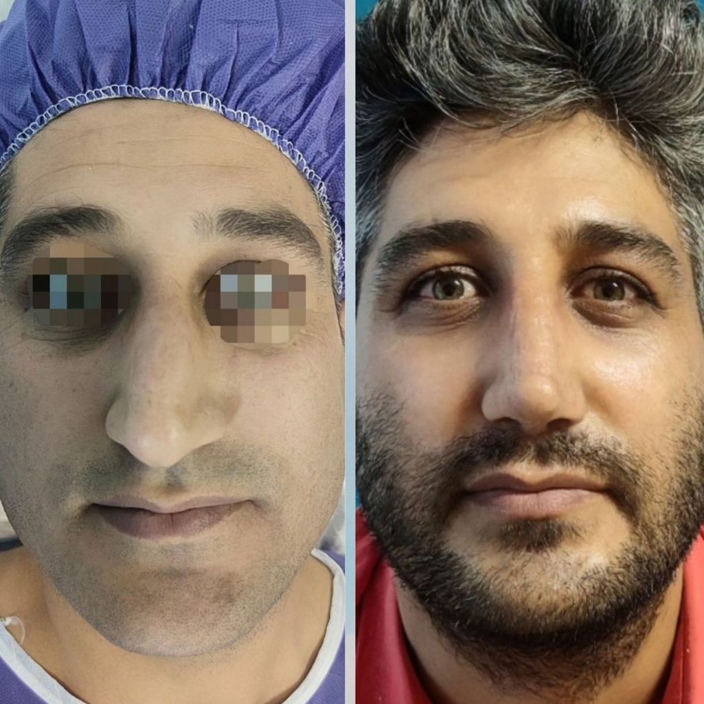 نمونه عمل بینی دکتر احمدرضا نورمحمدی؛ بهترین جراح بینی در لرستان