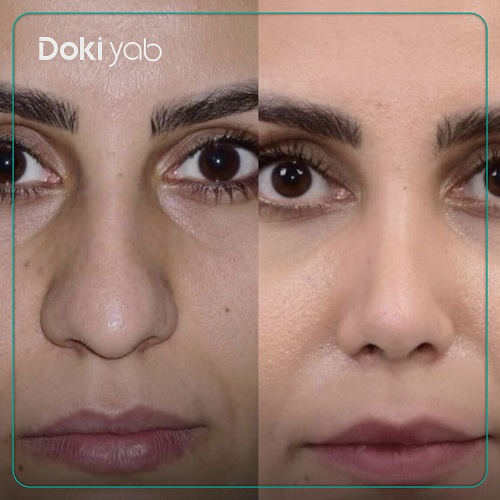 نمونه عمل بینی گوشتی دکتر امیر دریانی در تهران