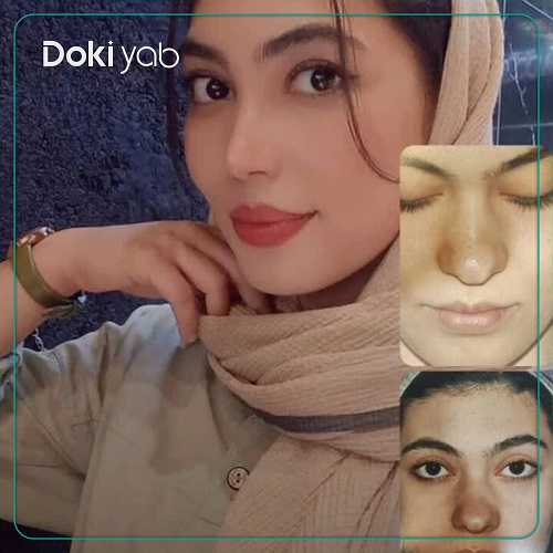 نمونه جراحی با دکتر حمیدرضا راستی بهترین جراح بینی گوشتی در تهران