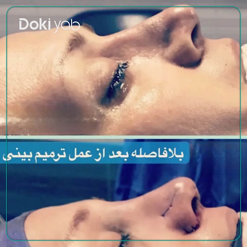 نمونه عمل بینی گوشتی دکتر کمال هادی در تهران