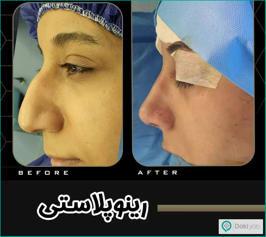 نمونه قبل و بعد عمل جراحی بینی کوتاه مردانه دکتر احمد رهنما