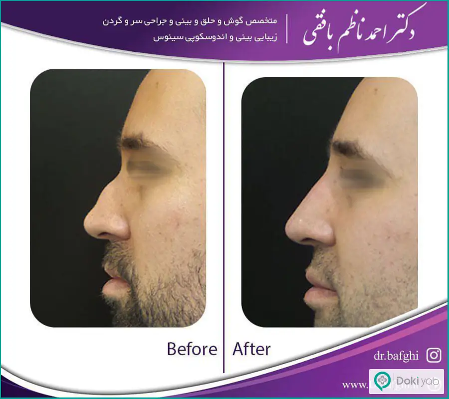 قبل و بعد عمل شکستگی بینی مردانه دکتر احمد نظام بافقی 