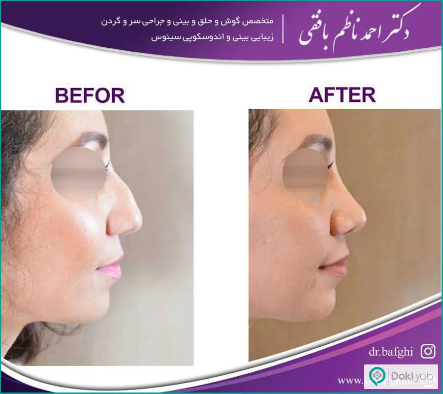 نمونه عمل جراحی شکستگی بینی طبیعی زنانه دکتر احمد نظام بافقی 
