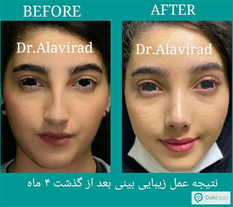 نمونه قبل و بعد عمل جراحی بینی کوتاه دکتر علی علوی راد