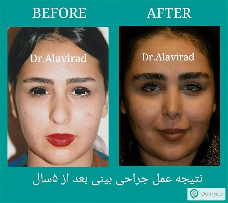 نمونه کار جراحی زیبایی بینی کوتاه دکتر علی علوی راد