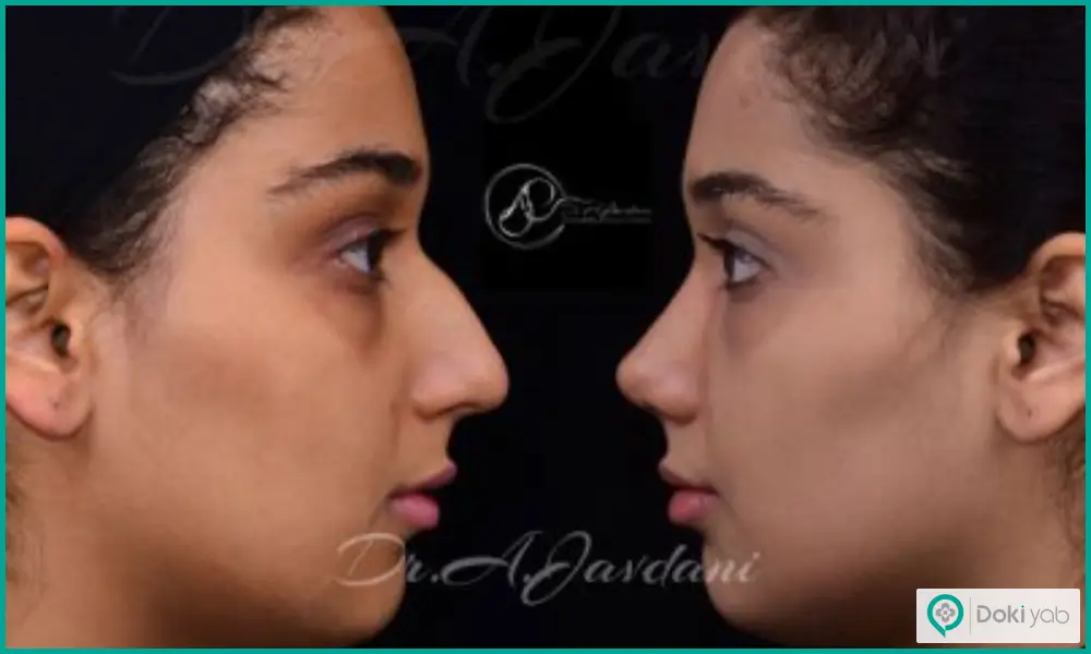 نمونه قبل و بعد عمل زیبایی بینی گوشتی زنانه دکتر علی جاودانی