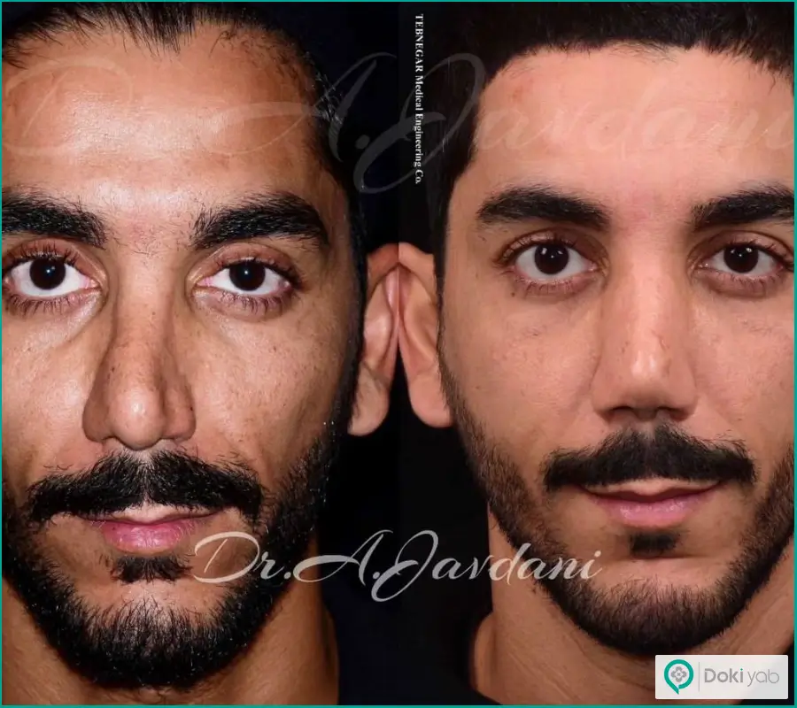 نمونه قبل و بعد عمل بینی بزرگ استخوانی مردانه دکتر علی جاودانی