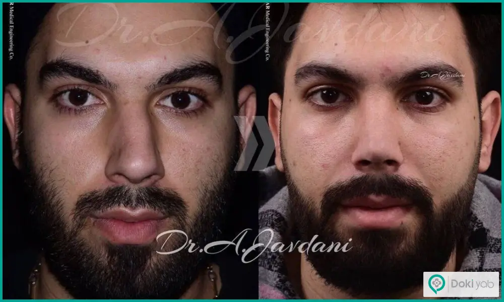 قبل و بعد عمل شکستگی بینی مردانه دکتر علی جاودانی