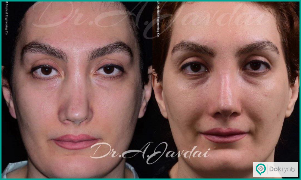 قبل و بعد جراحی شکستگی بینی طبیعی زنانه دکتر علی جاودانی