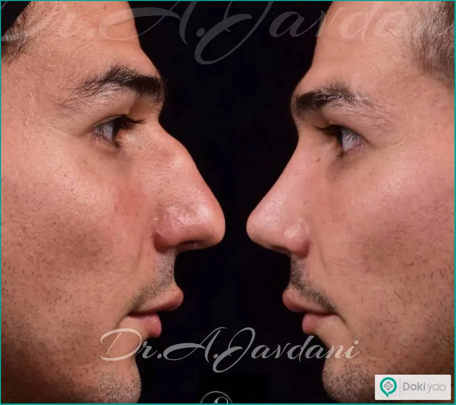 قبل و بعد عمل جراحی بینی استخوانی مردانه دکتر علی جاودانی