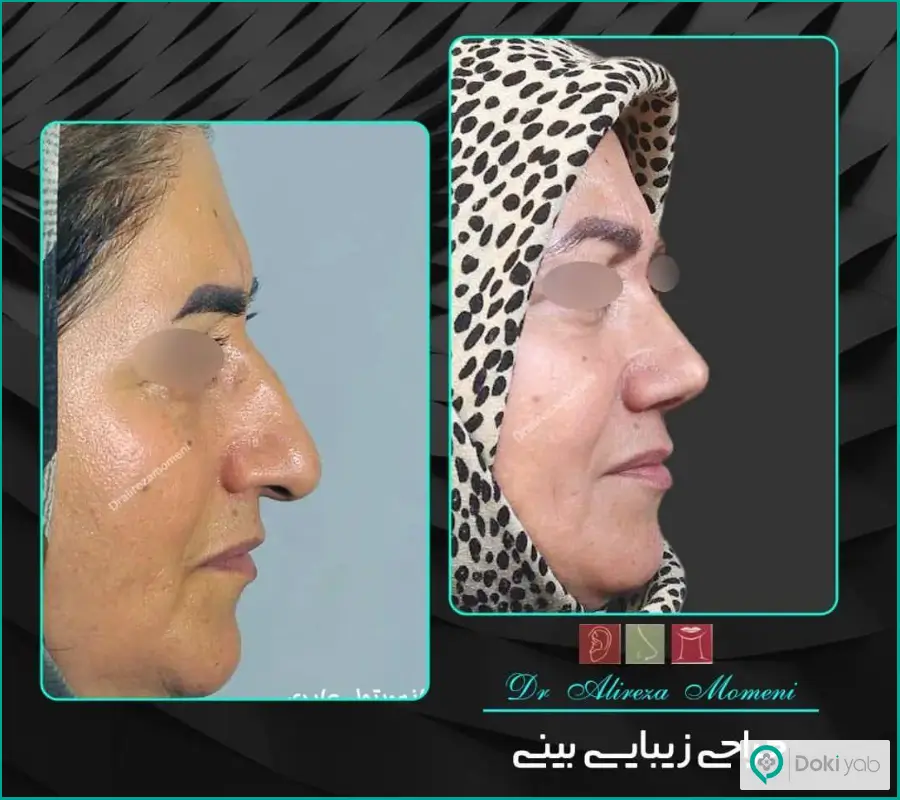 قبل و بعد کوچک کردن بینی عقابی زنانه دکتر علیرضا مومنی