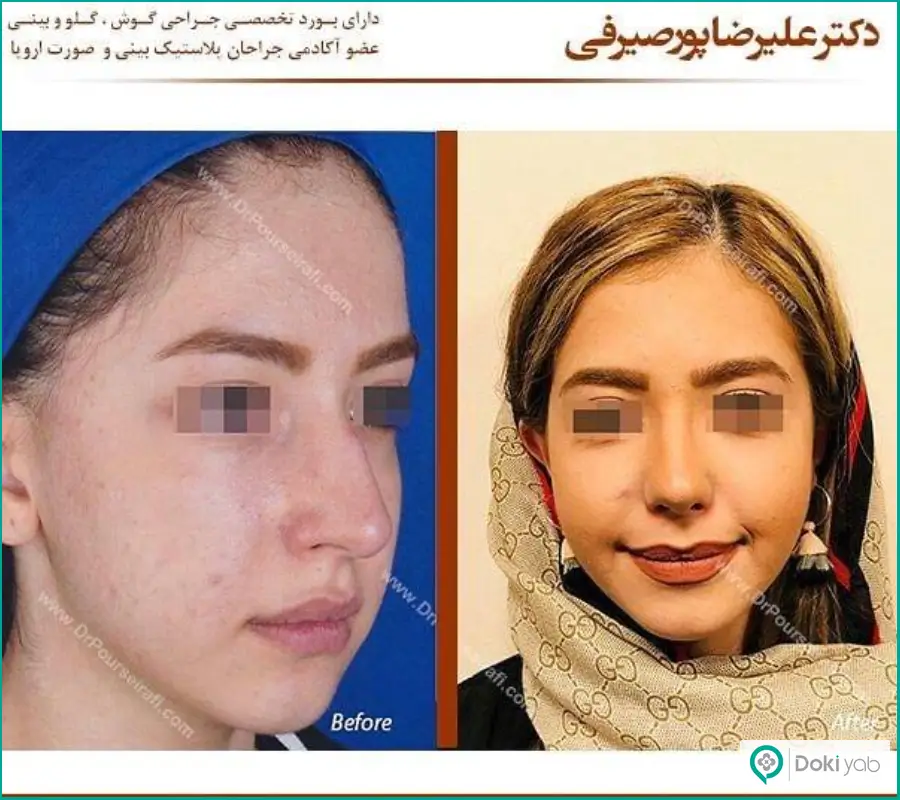 قبل و بعد عمل جراحی شکستگی بینی دخترانه دکتر علیرضا پور صیرفی