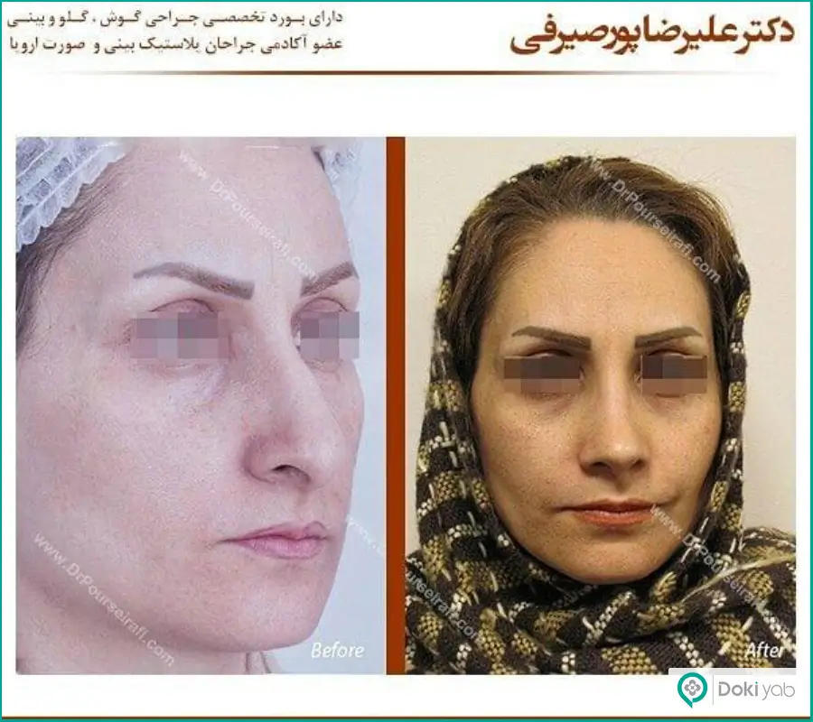 قبل و بعد جراحی بینی شکسته طبیعی زنانه دکتر علیرضا پورصیرفی