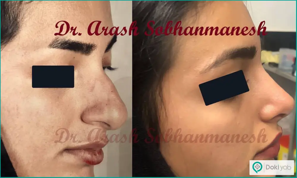 قبل و بعد عمل بینی گوشتی زنانه مدل طبیعی دکتر آرش سبحان منش