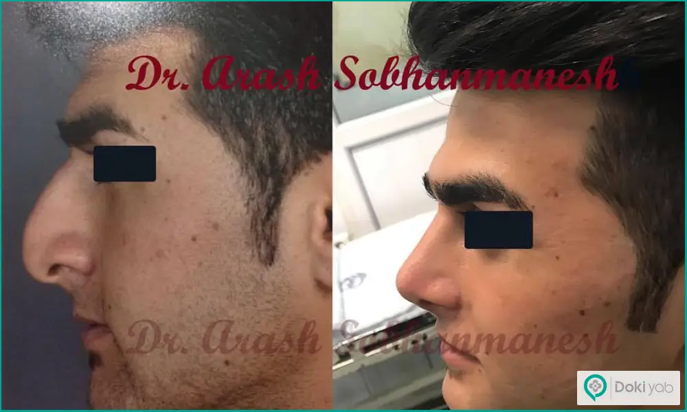 نمونه قبل و بعد عمل جراحی دماغ گوشتی مردانه دکتر آرش سبحان منش در شیراز