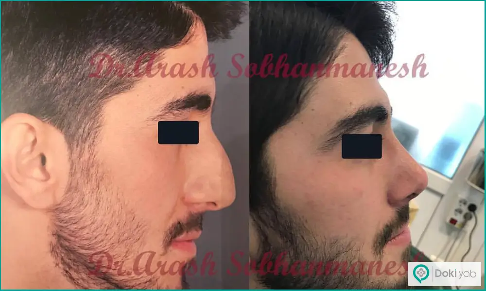 نمونه کار قبل و بعد جراحی زیبایی بینی گوشتی مردانه دکتر آرش سبحان منش در شیراز