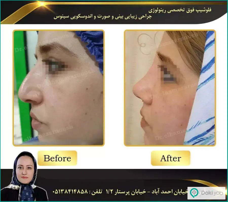 نمونه کار قبل و بعد جراحی زیبایی بینی بزرگ دکتر الهام آذرنوش