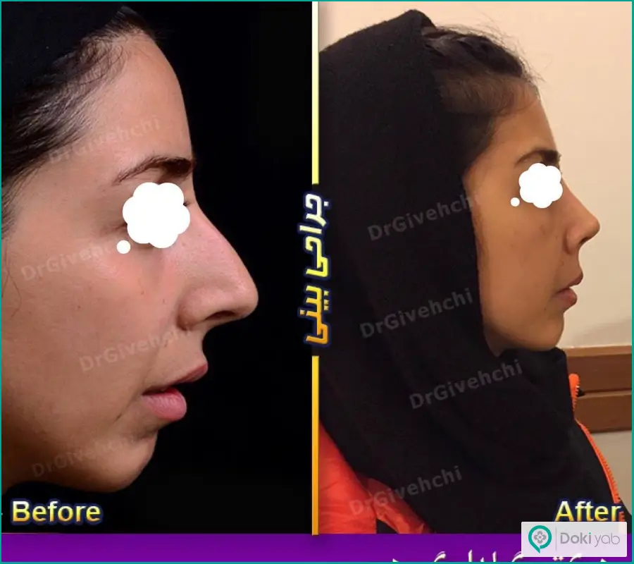 عکس قبل و بعد جراحی شکستگی بینی زنانه دکتر گیلدا گیوه چی