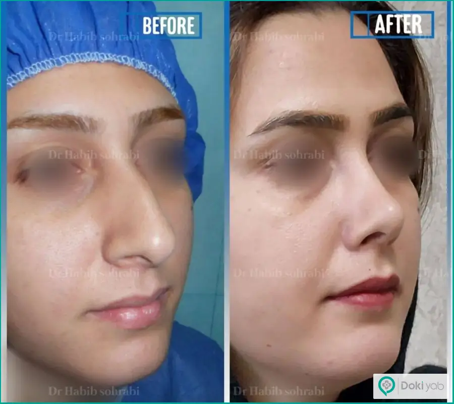 قبل و بعد جراحی زیبایی دماغ زنانه مدل فانتزی دکتر حبیب سهرابی