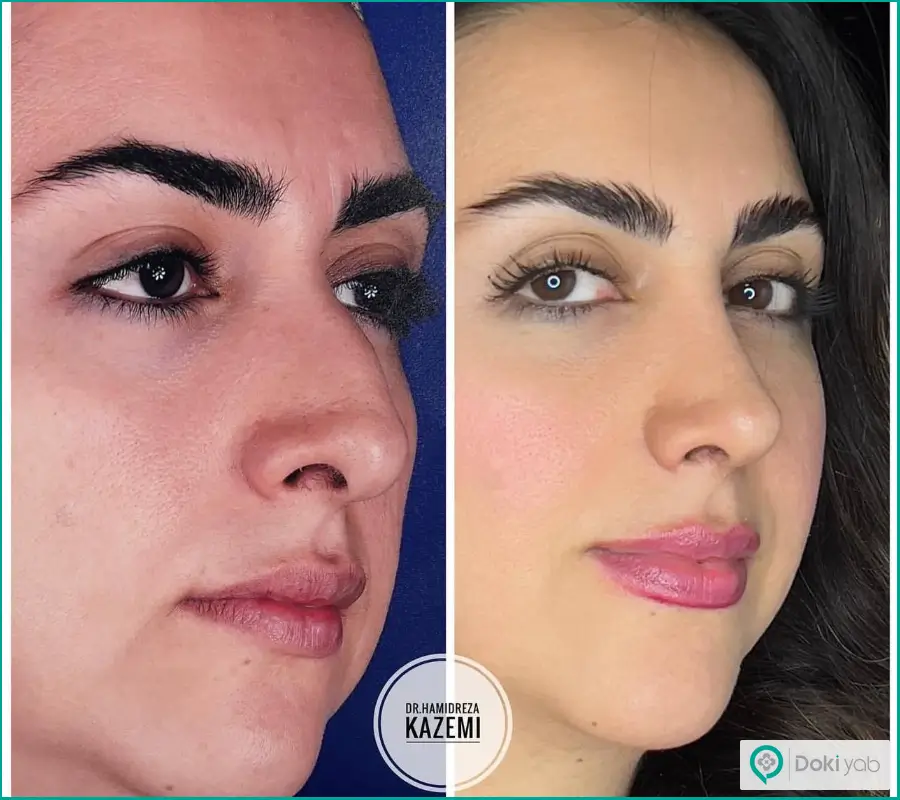 قبل و بعد عمل زیبایی بینی کوتاه زنانه دکتر حمیدرضا کاظمی