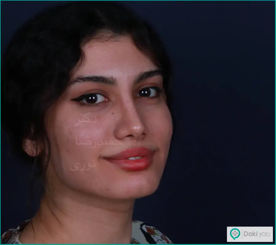 جراحی زیبایی بینی بزرگ دکتر حمیدرضا نوری در تهران
