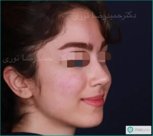 نمونه عمل بینی با دکتر حمید نوری جراح بینی در تهران