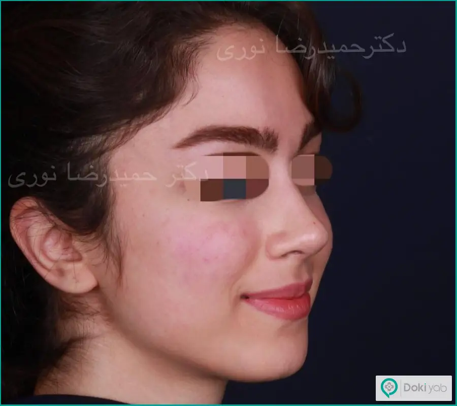 عمل زیبایی دماغ دکتر حمیدرضا نوری در تهران