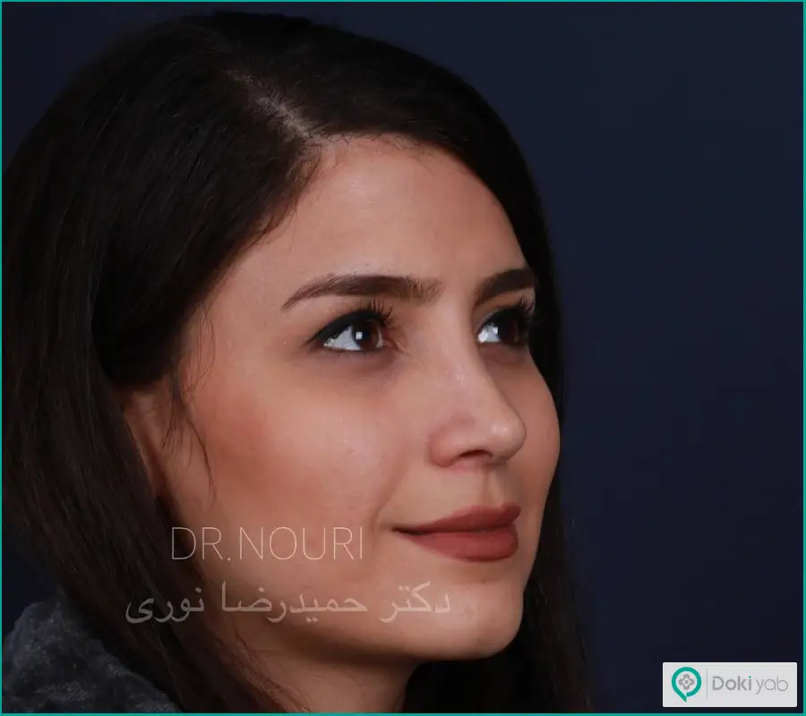 عمل جراحی بینی زنانه دکتر حمیدرضا نوری در تهران