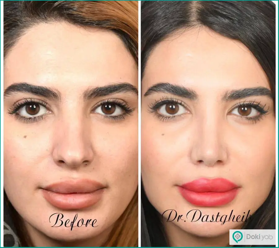 قبل و بعد جراحی بینی نیمه فانتزی نوک گرد زنانه دکتر حسن دستغیب
