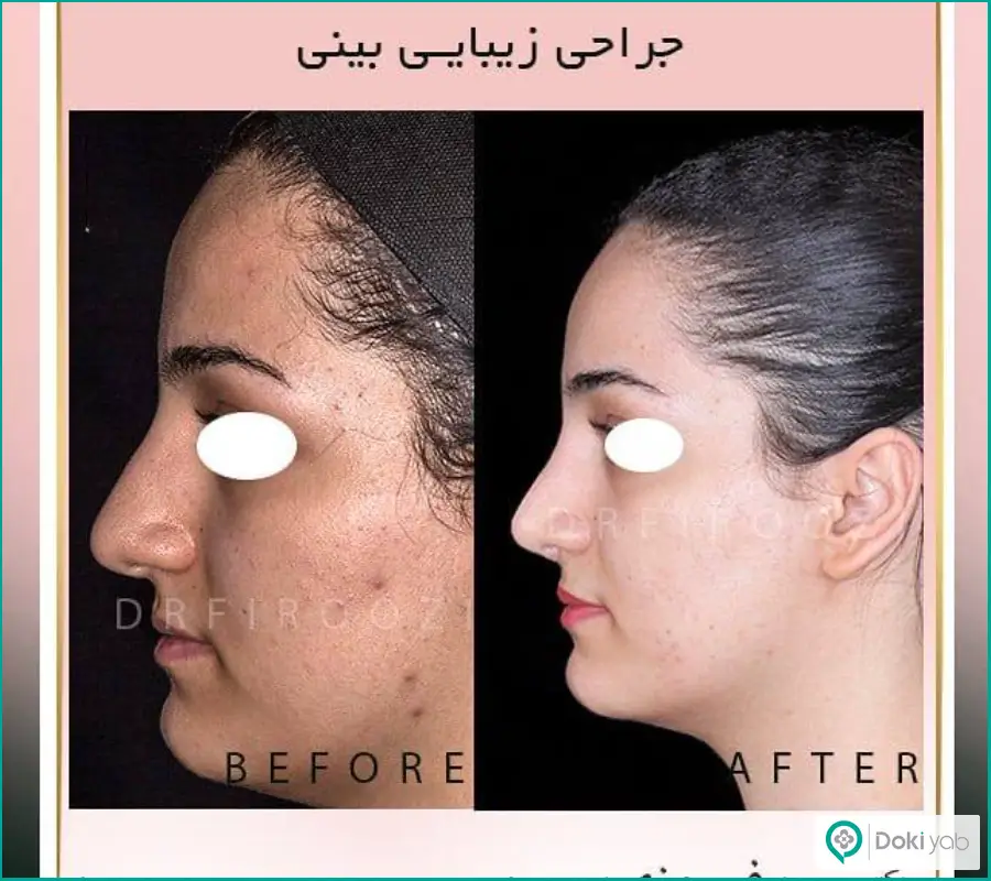 قبل و بعد جراحی دماغ گوشتی طبیعی زنانه دکتر حسین فیروزی