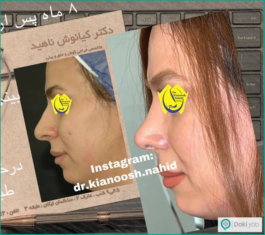 نمونه قبل و بعد عمل زیبایی بینی زنانه دکتر کیانوش ناهید