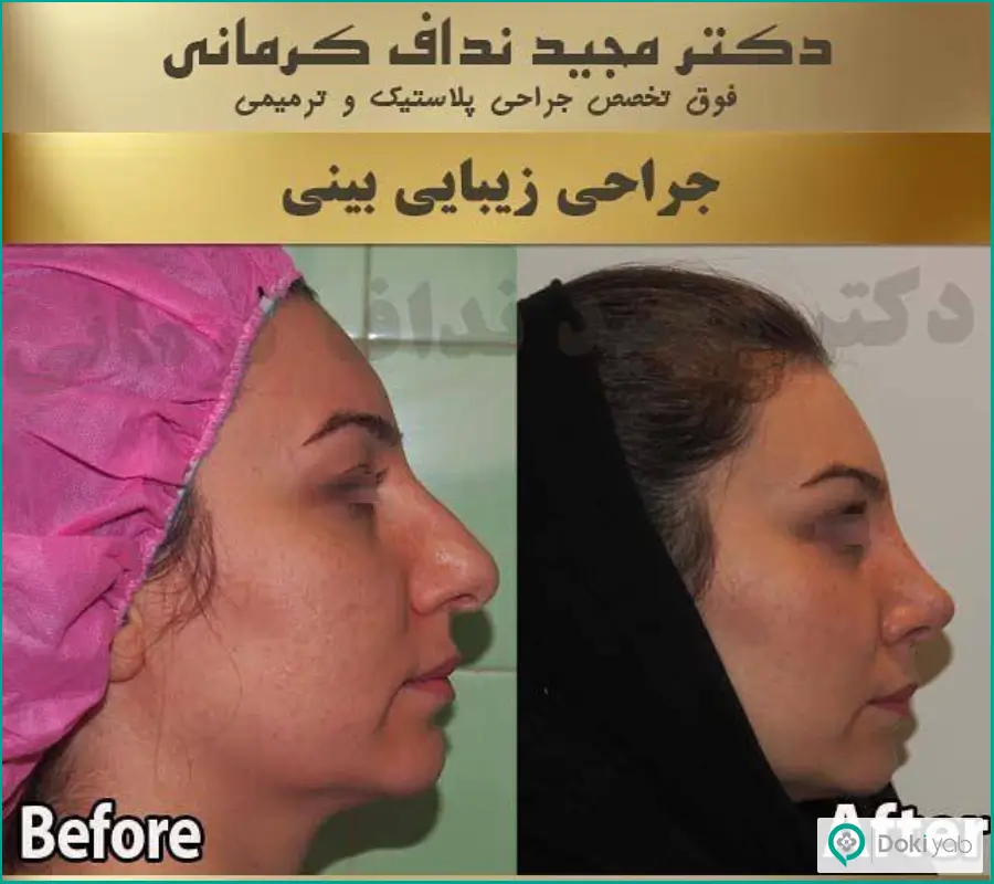 قبل و بعد عمل جراحی بینی گوشتی سبک طبیعی زنانه دکتر مجید نداف کرمانی