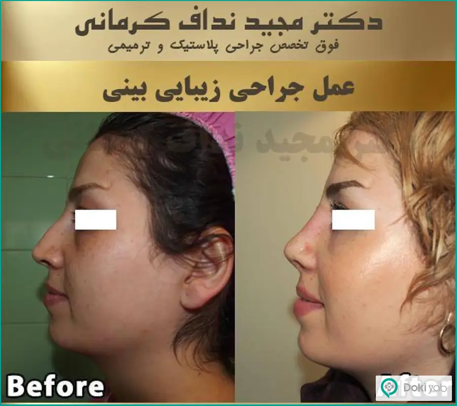 نمونه کار جراحی بینی گوشتی زنانه دکتر مجید نداف کرمانی