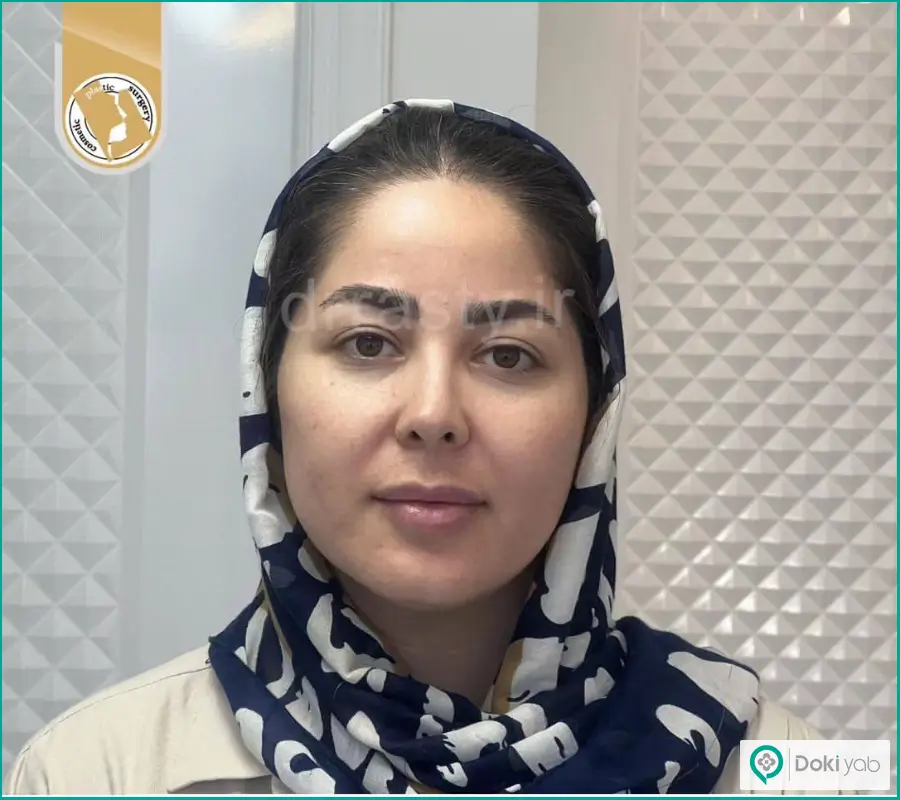 نمونه عمل جراحی بینی زنانه دکتر مجید راستی در اصفهان
