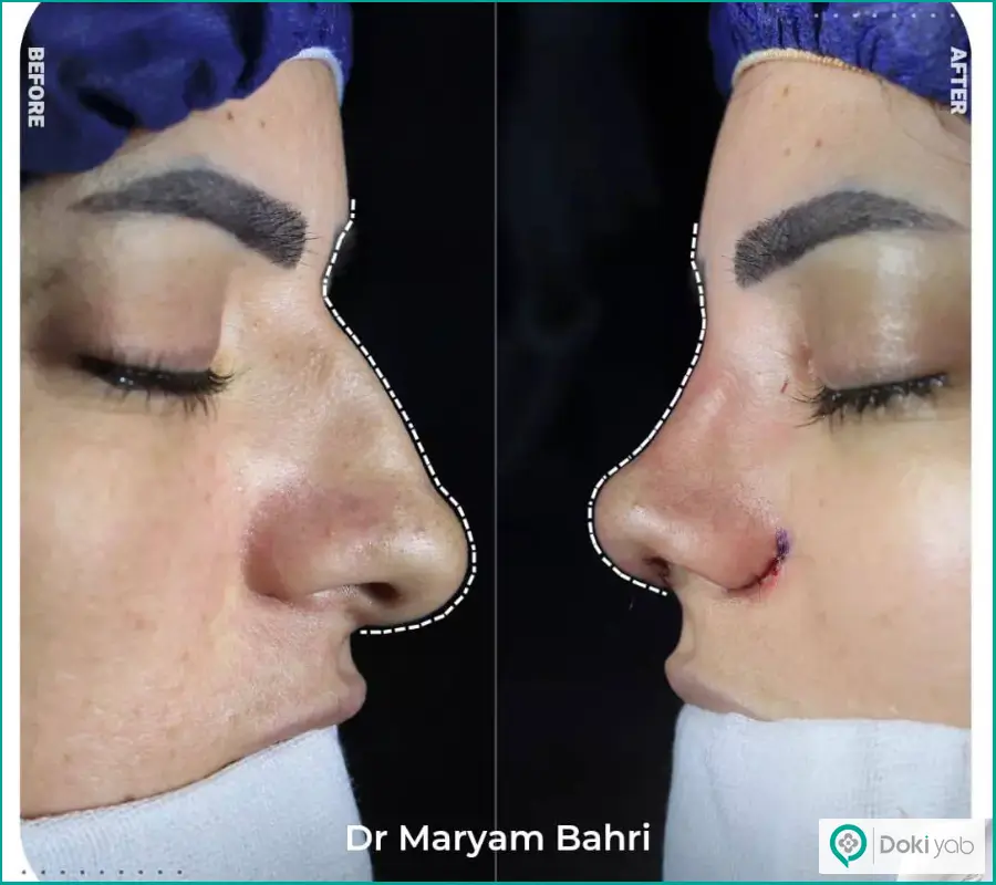 قبل و بعد عمل جراحی بینی عقابی دکتر مریم بحری