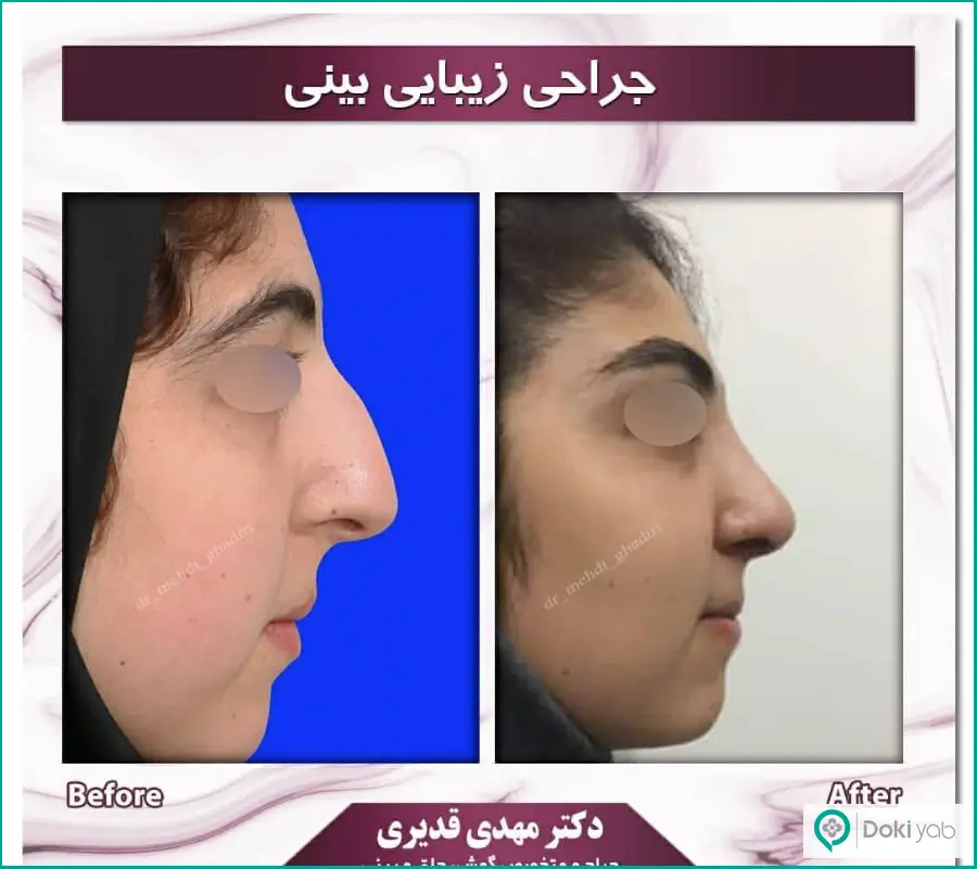 قبل و بعد عمل زیبایی بینی کج دخترانه دکتر مهدی قدیری در اصفهان