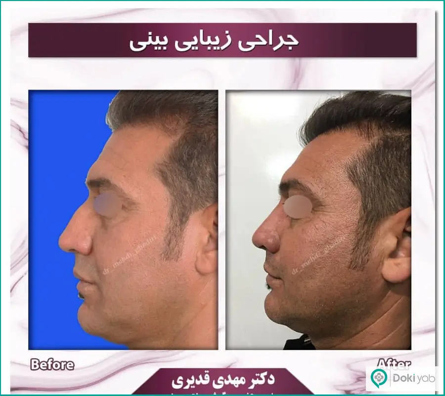 قبل و بعد عمل بینی مردانه دکتر مهدی قدیری در اصفهان