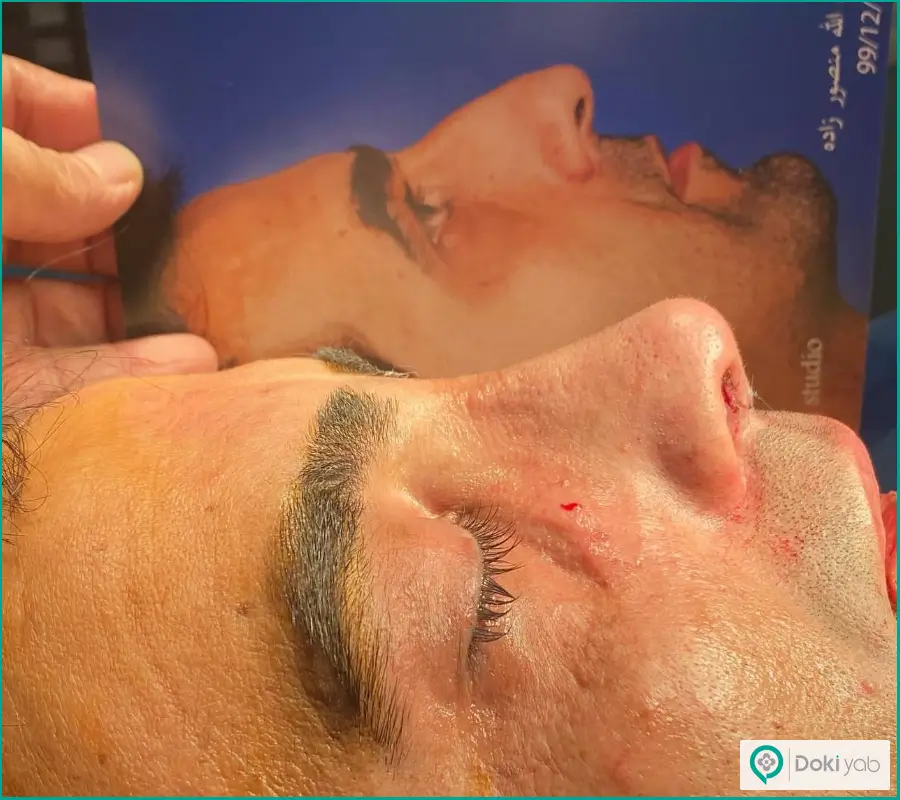 قبل و بعد عمل بینی بزرگ استخوانی به روش بسته مردانه دکتر محمد طرزی