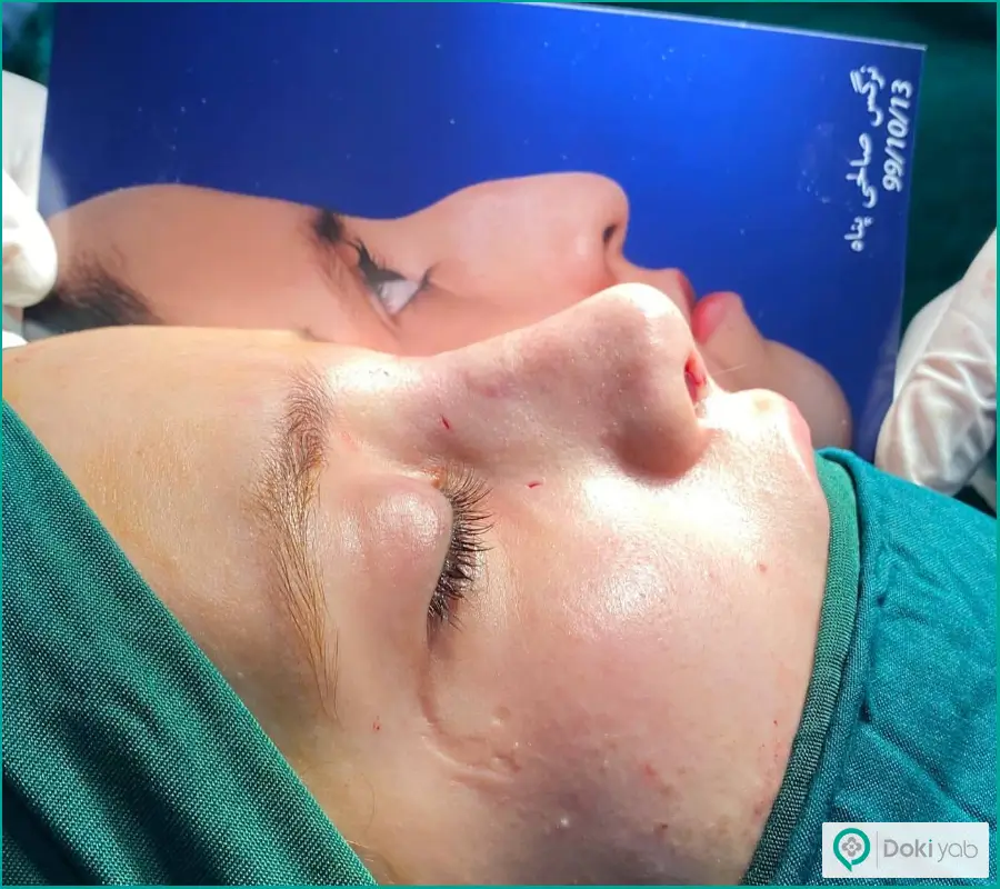 قبل و بعد عمل زیبایی بینی بزرگ استخوانی زنانه دکتر محمد طرزی