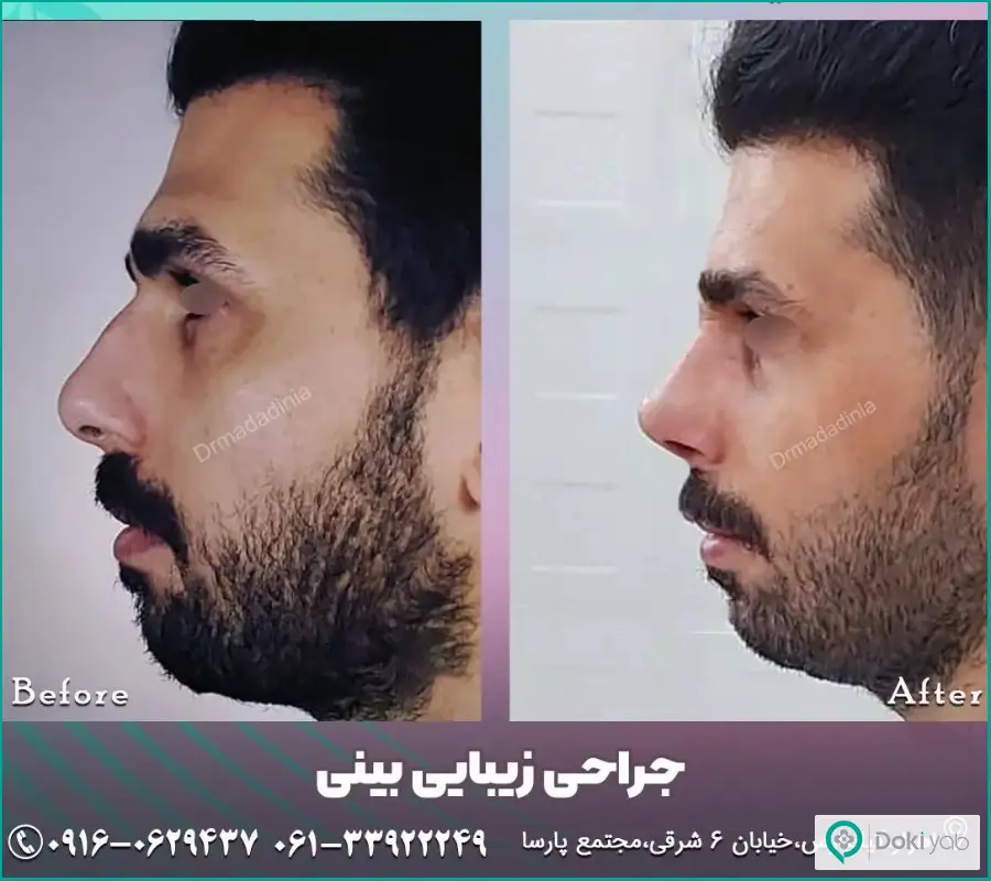 نمونه قبل و بعد رینوپلاستی بینی بزرگ مردانه دکتر مینو مددی