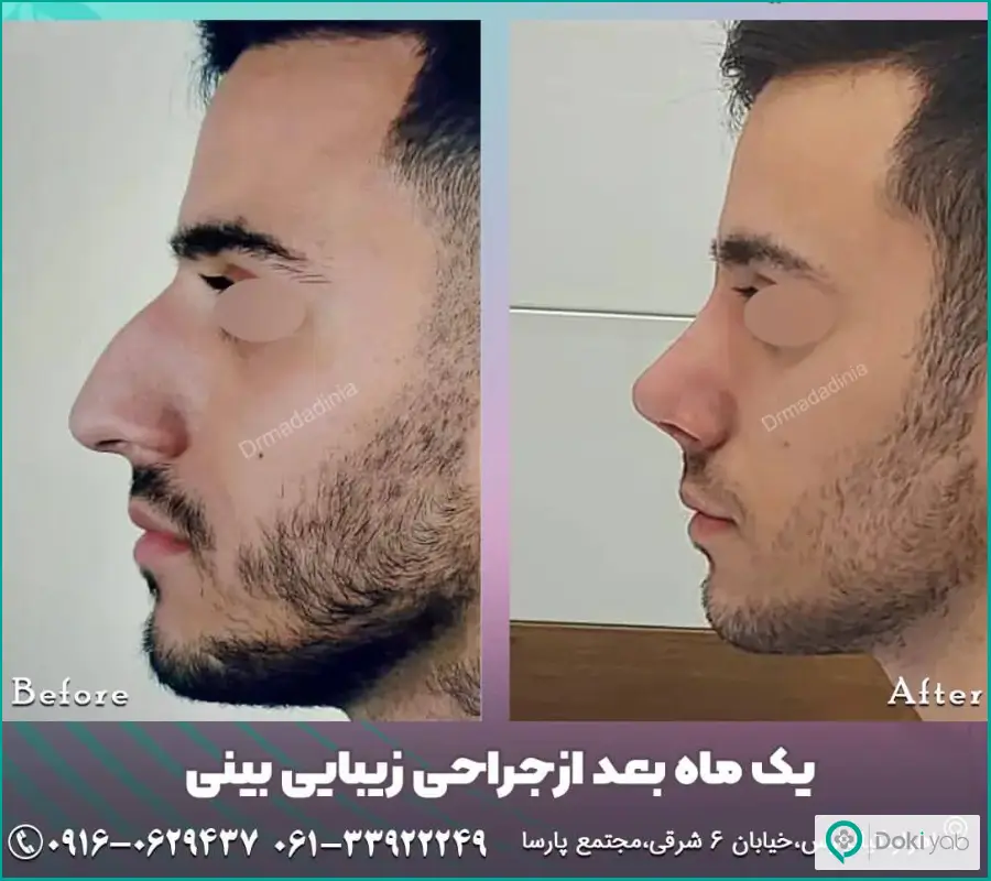 قبل و بعد عمل زیبایی بینی بزرگ مردانه دکتر مینو مددی