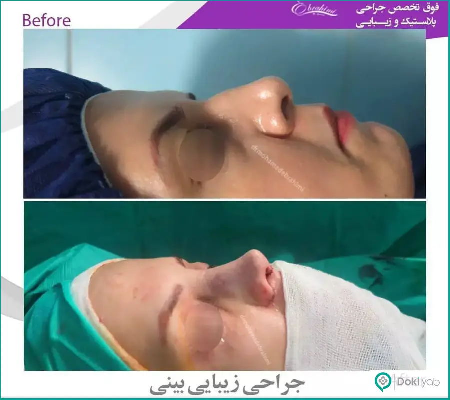 قبل و بعد عمل بینی گوشتی زنانه دکتر محمد ابراهیمی
