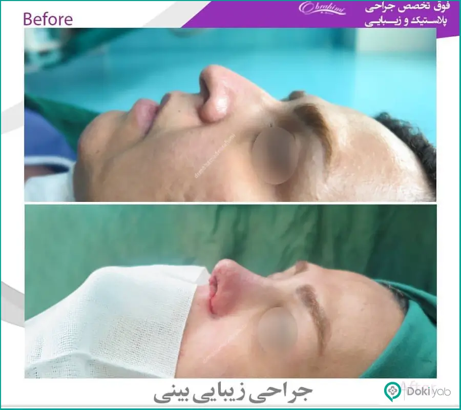 نمونه قبل و بعد عمل زیبایی دماغ طبیعی زنانه دکتر محمد ابراهیمی